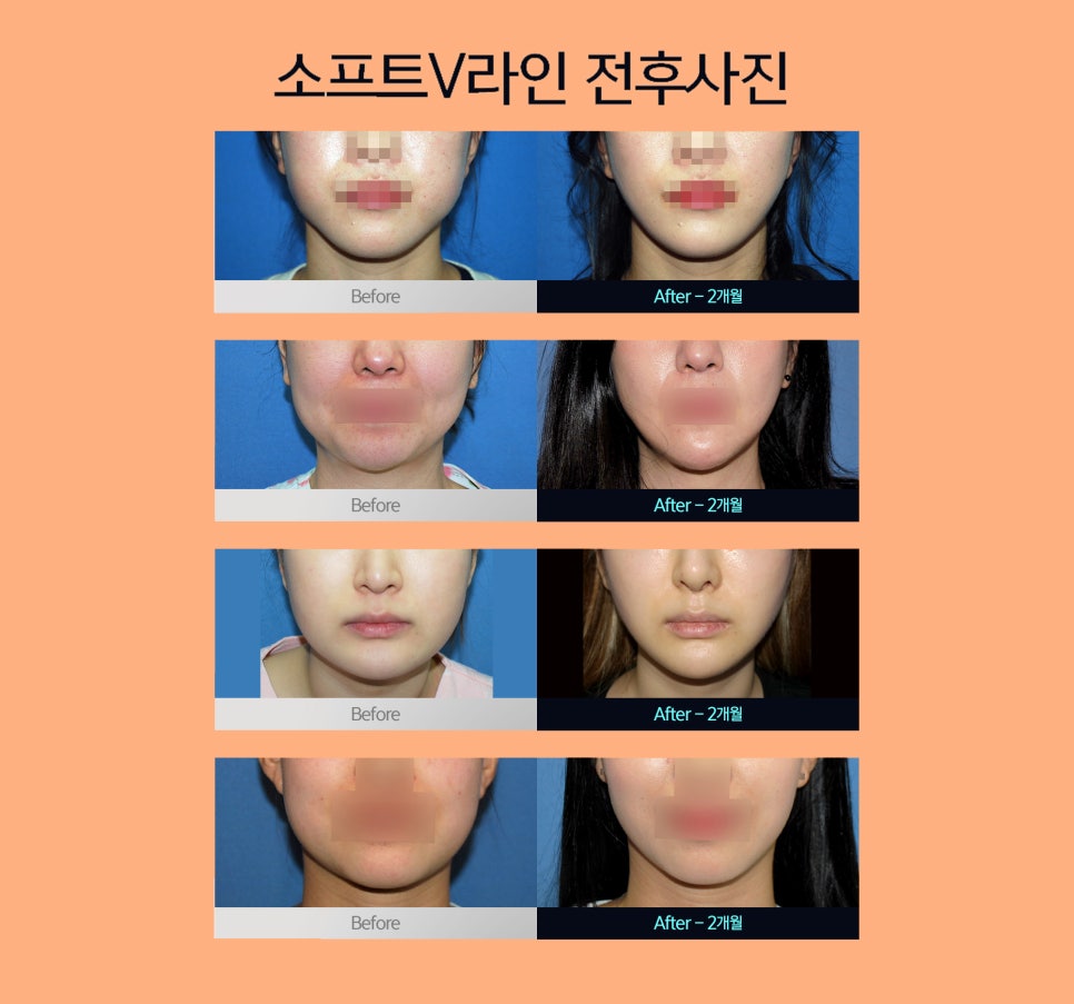 요즘 다 한다는 얼굴갸름해지는법 관련 이미지 6