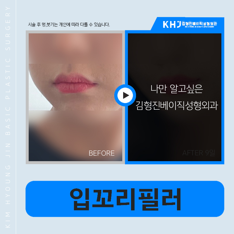 If you’re worried about asymmetrical mouth corners, this alone is enough image 5