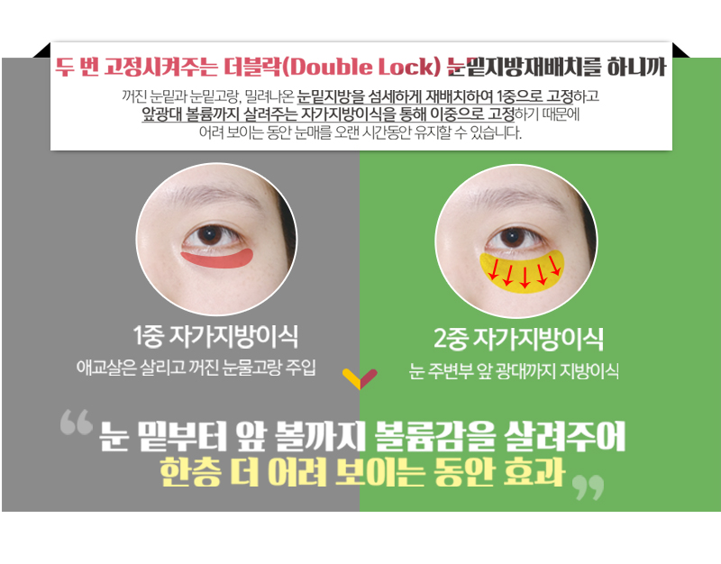눈밑지방재배치붓기 걱정되신다구요? 관련 이미지 2