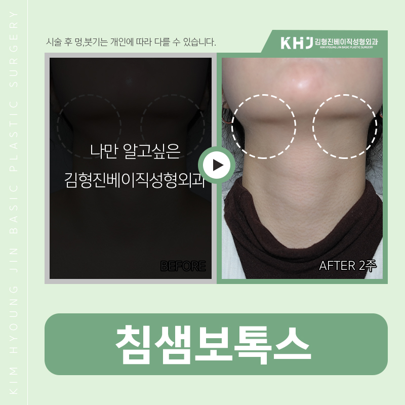 침샘보톡스주기 어떻게 되냐면요 관련 이미지 4