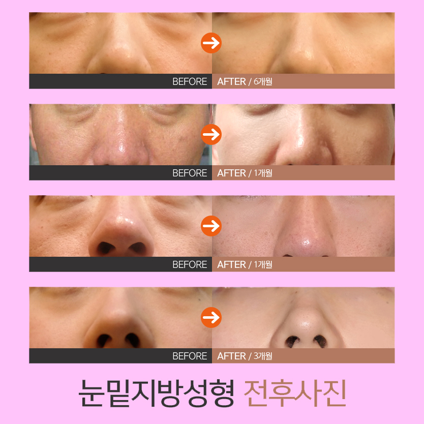 믿고 받을 수 있는 압구정눈밑지 맛집에서 성공! 관련 이미지 6