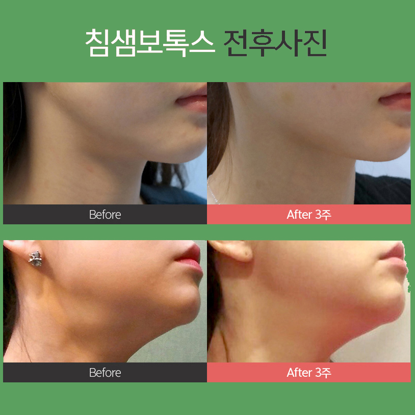 침샘보톡스전후 이중턱이랑 이별했어요 관련 이미지 6