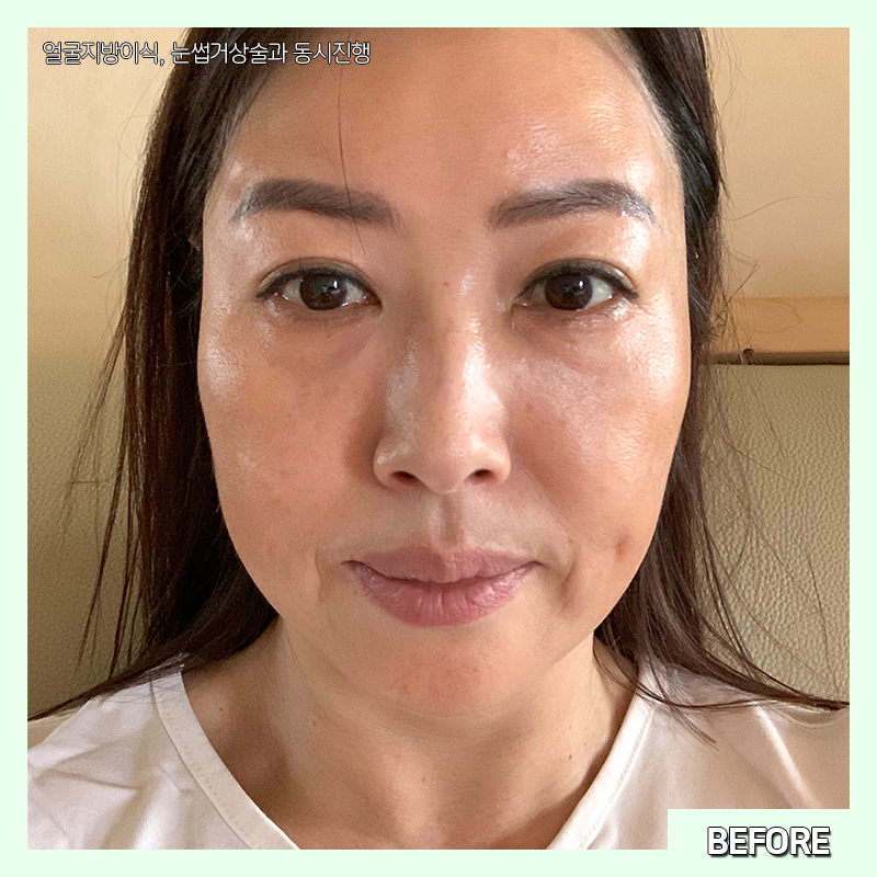 미니하안검붓기 궁금하셨다구요? 관련 이미지 2