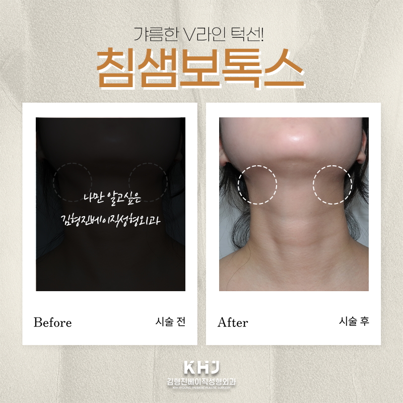 침샘비대증치료 김형진베이직에서 하셔야죠! 관련 이미지 6