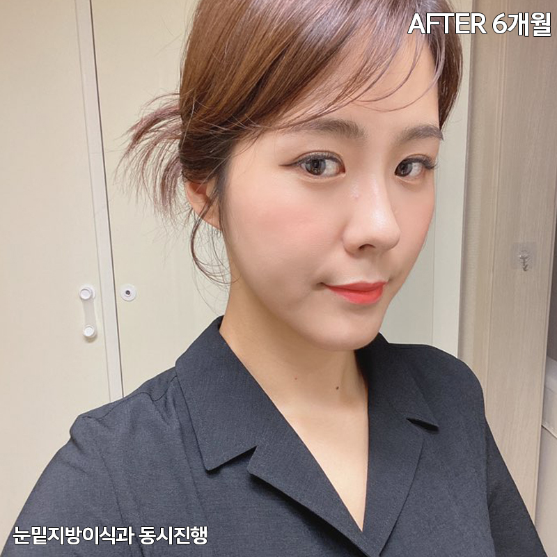 눈밑지방재배치유지력 하면 김형진베이직 관련 이미지 6