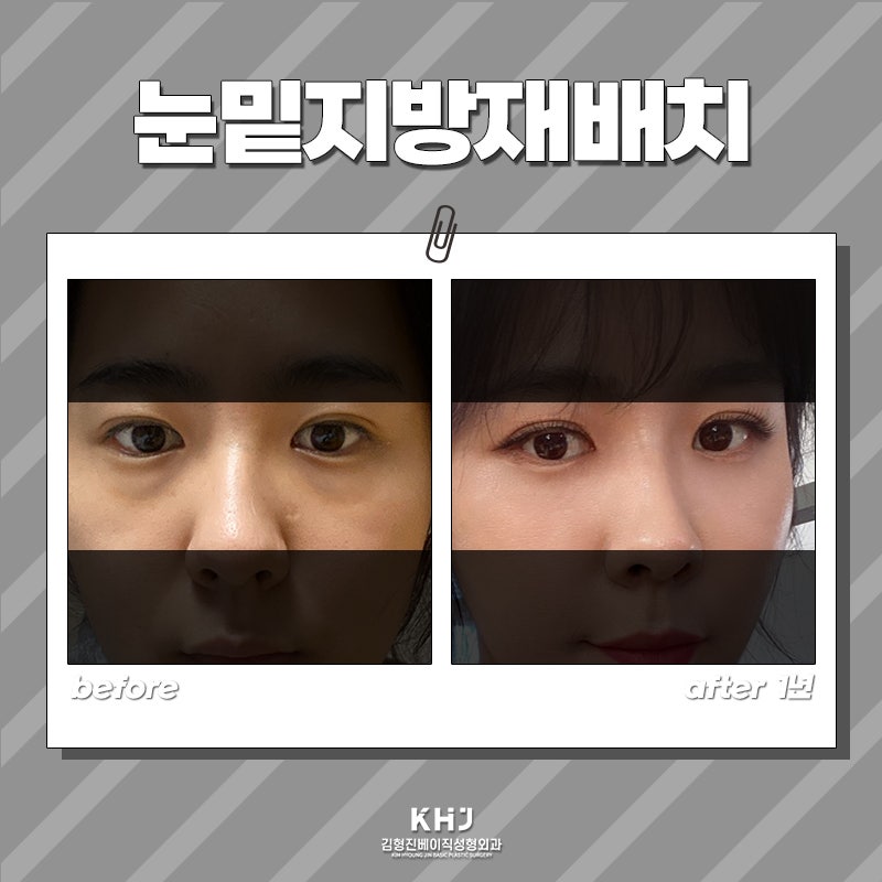 울룩불룩한 눈 밑, 눈밑지방재배치수술로 해결했어요 관련 이미지 6