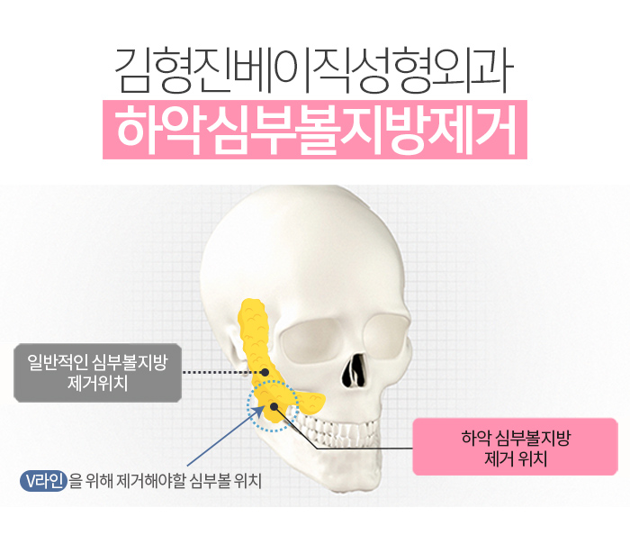 심부볼지방제거가격 싼 곳 보다는 실력이 중요! 관련 이미지 4