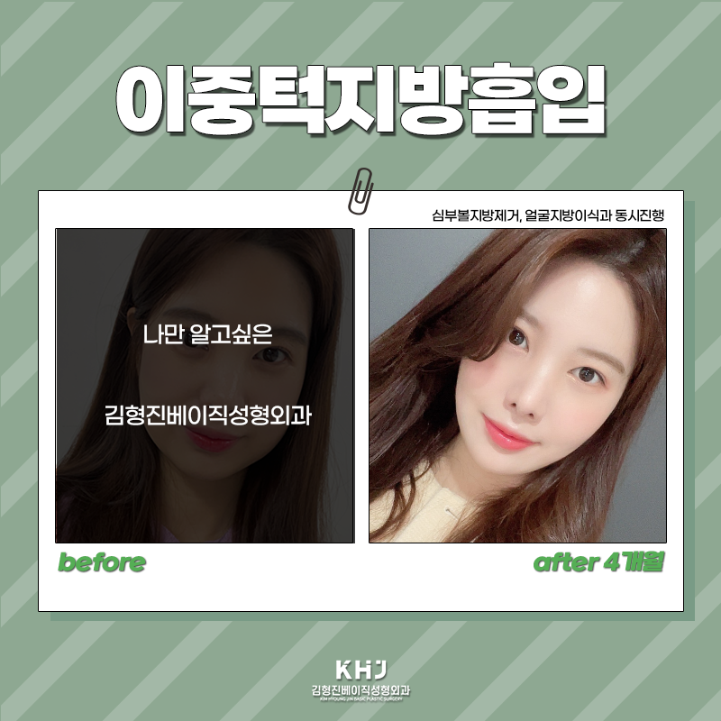 압구정이중턱지방흡입 어디가 좋을까 고민중이시라면? 관련 이미지 6