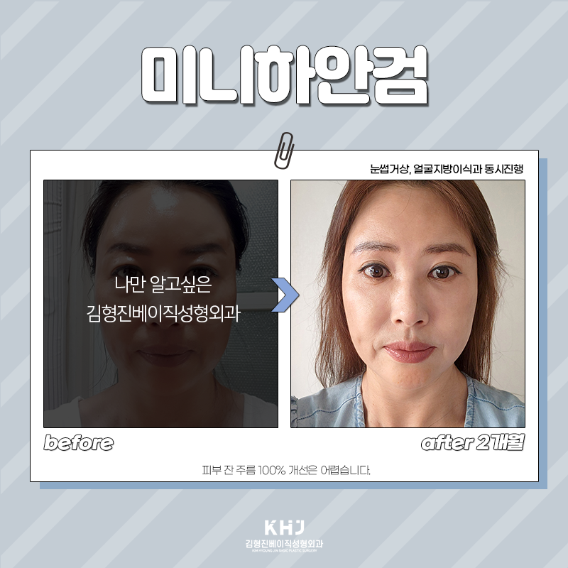 미니하안검절개 부담 갖지 마세요! 관련 이미지 4