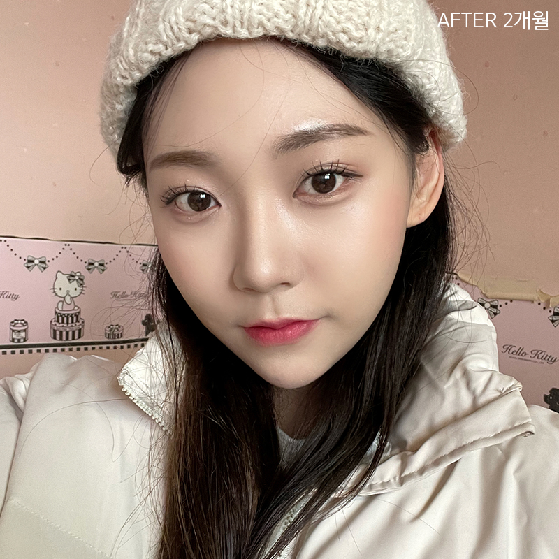 심부볼제거잘하는곳은? 바로 김형진베이직이죠! 관련 이미지 5