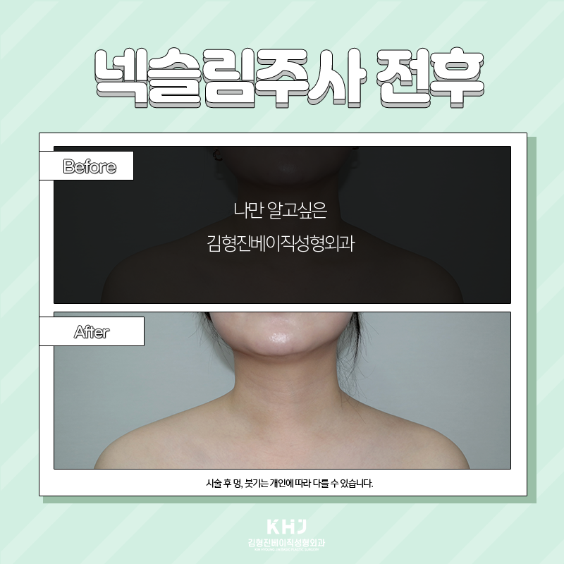 웨딩시술 고민하지 말고 김형진베이직에서! 관련 이미지 4