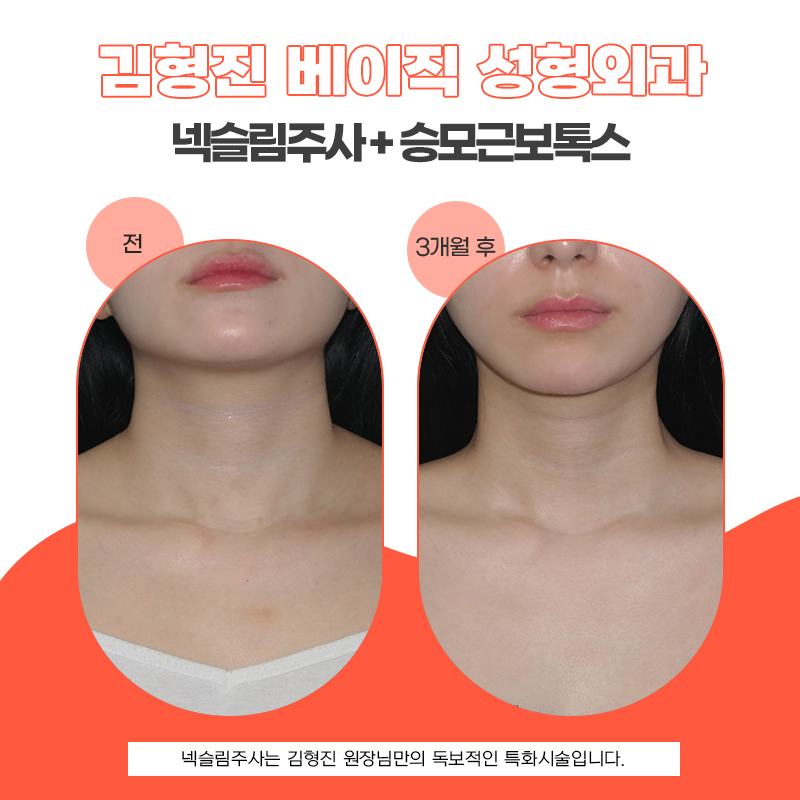 혹시 나도 물갈퀴목? 목보톡스로 해결이 되긴 하네요 관련 이미지 5