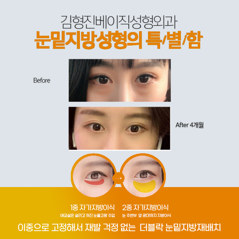 눈밑지전후 차이가 확실한 곳에서 관련 이미지 4