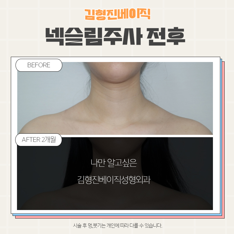 목보톡스후기 김형진베이직만 한 곳 없죠 관련 이미지 4