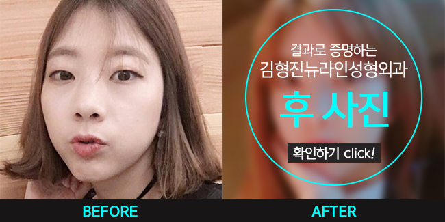 부분절개로 쌍꺼풀 내것인듯 자연스럽게! 관련 이미지 7