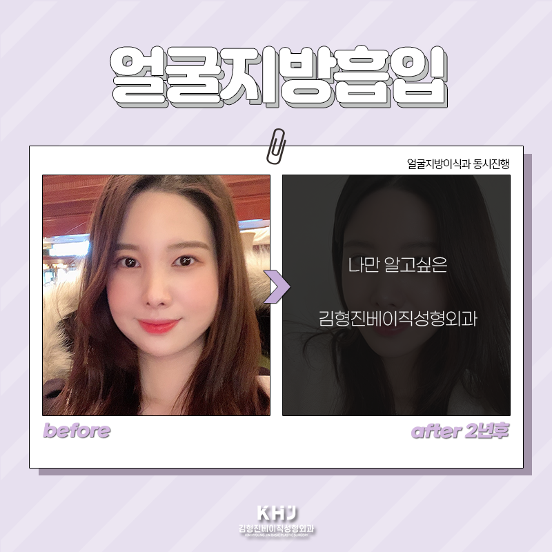 얼굴지방흡입전후 확인하고 가세요! 관련 이미지 3