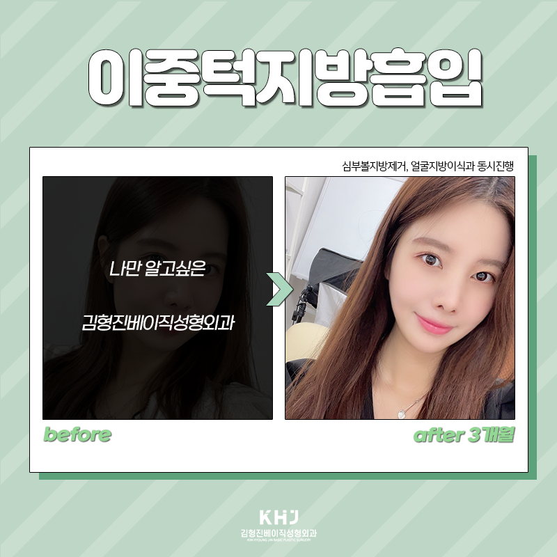 이중턱지방흡입전후 확인하고 가세요! 관련 이미지 3