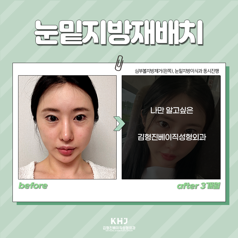 눈밑지방재배치전후 보고 가세요! 관련 이미지 5