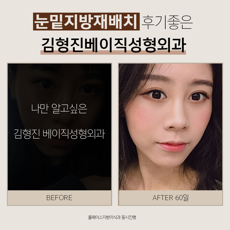 눈밑지방재배치후기 봐주실 분 관련 이미지 3