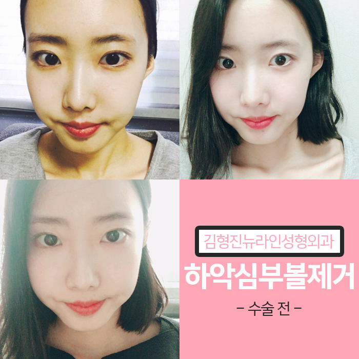 하악심부볼지방제거 안전과 부작용을 생각한다면 관련 이미지 3