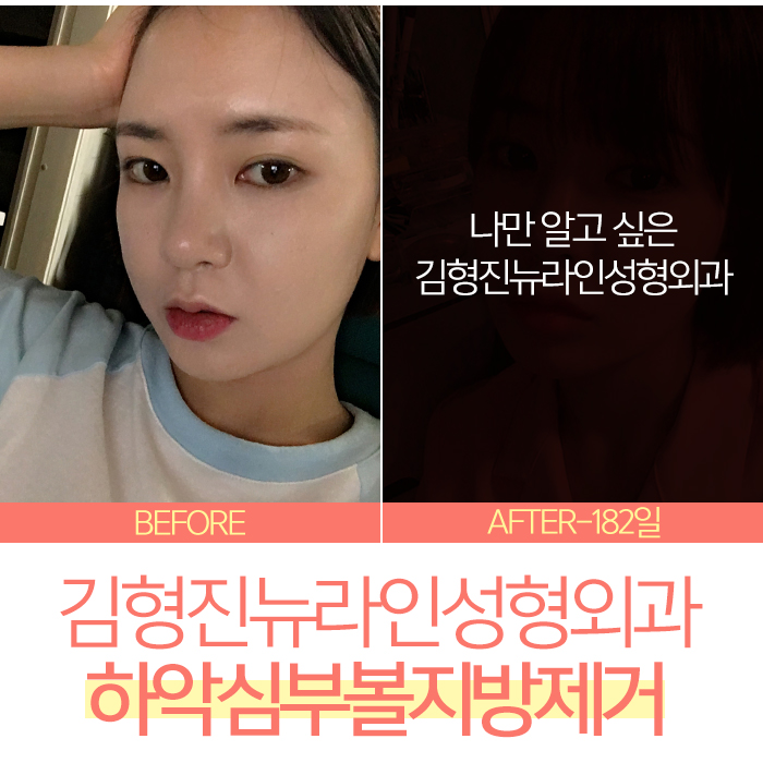 하악심부볼지방제거 어디다? 김형진뉴라인성형외과다! 관련 이미지 8