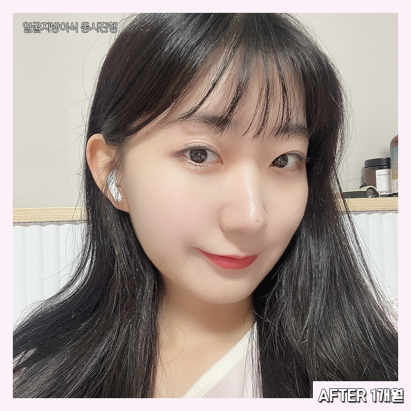 얼굴지방흡입효과 제대로 보려면 관련 이미지 6