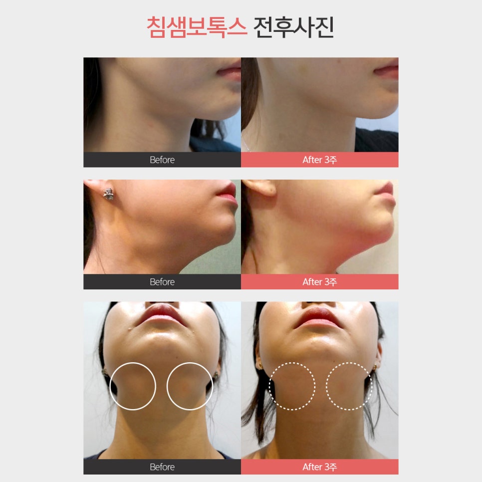 침샘보톡스추천 어디서 할지 아직 못정했다면 관련 이미지 6