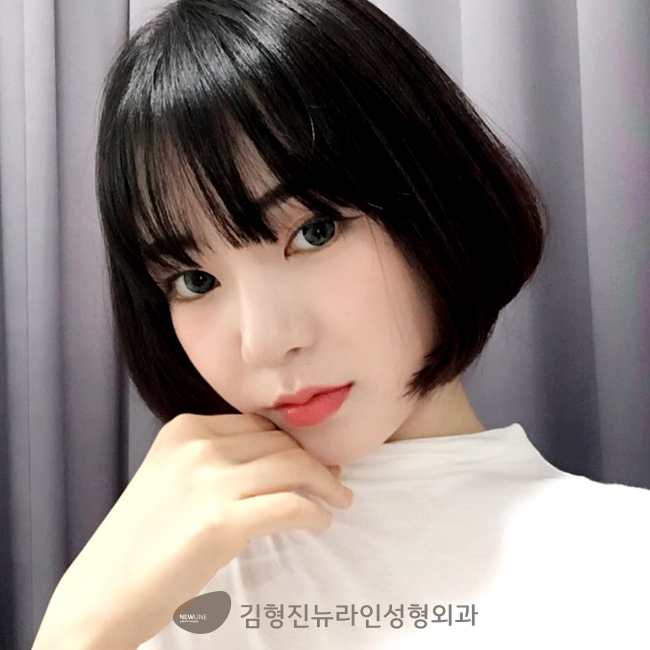 풀페이스지방이식후기 직접 확인하기! 관련 이미지 3