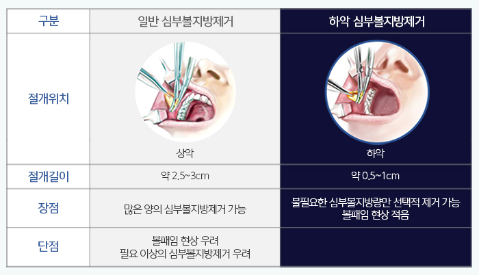 하악심부볼지방제거 수술로 부작용없는 김형진뉴라인성형외과 관련 이미지 4