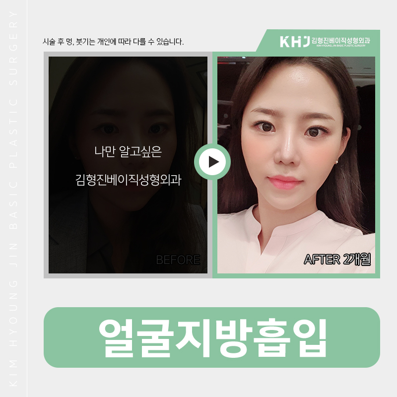 얼굴지방흡입부작용 없는 이유? 관련 이미지 4