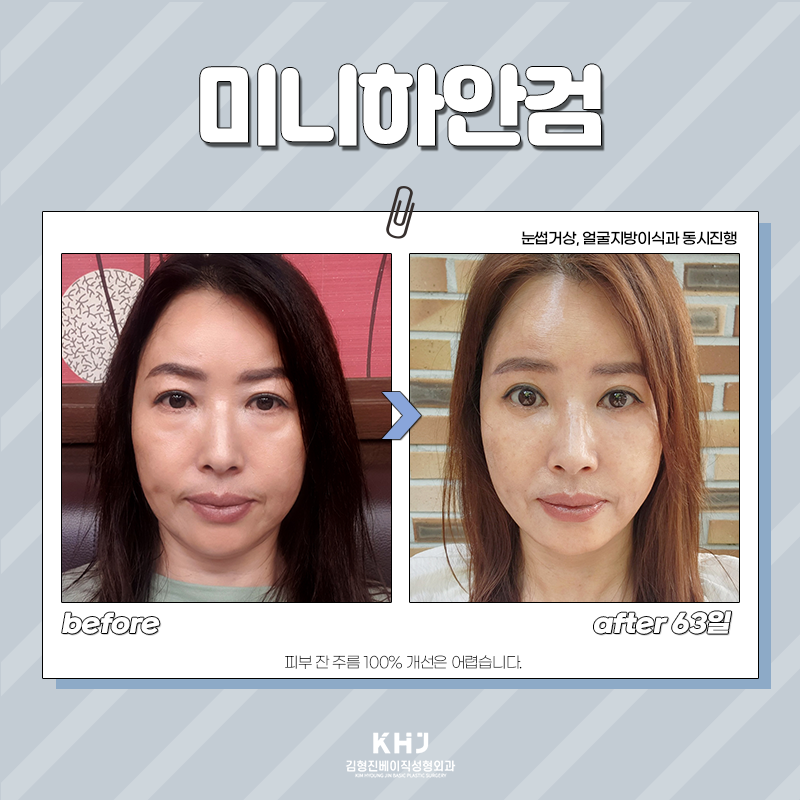 Still 고민 about under-eye surgery in middle age? image 5