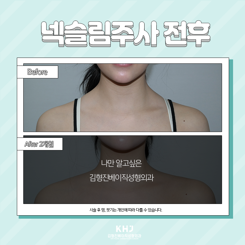 두꺼운목 고민은 이제 그만~! 관련 이미지 5