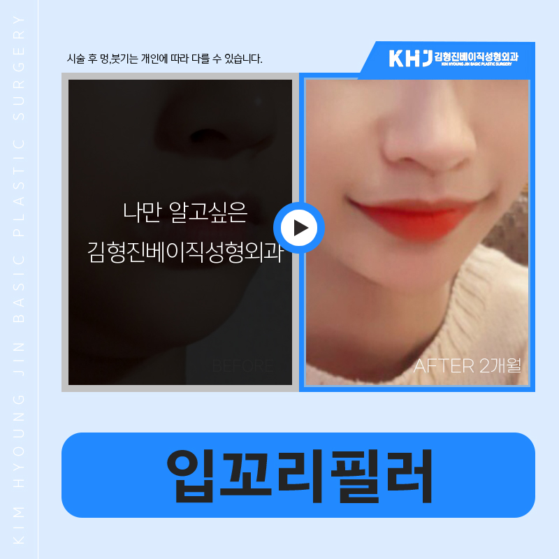 압구정입꼬리필러후기 이만큼 만족스러울 수가 없어요 관련 이미지 6
