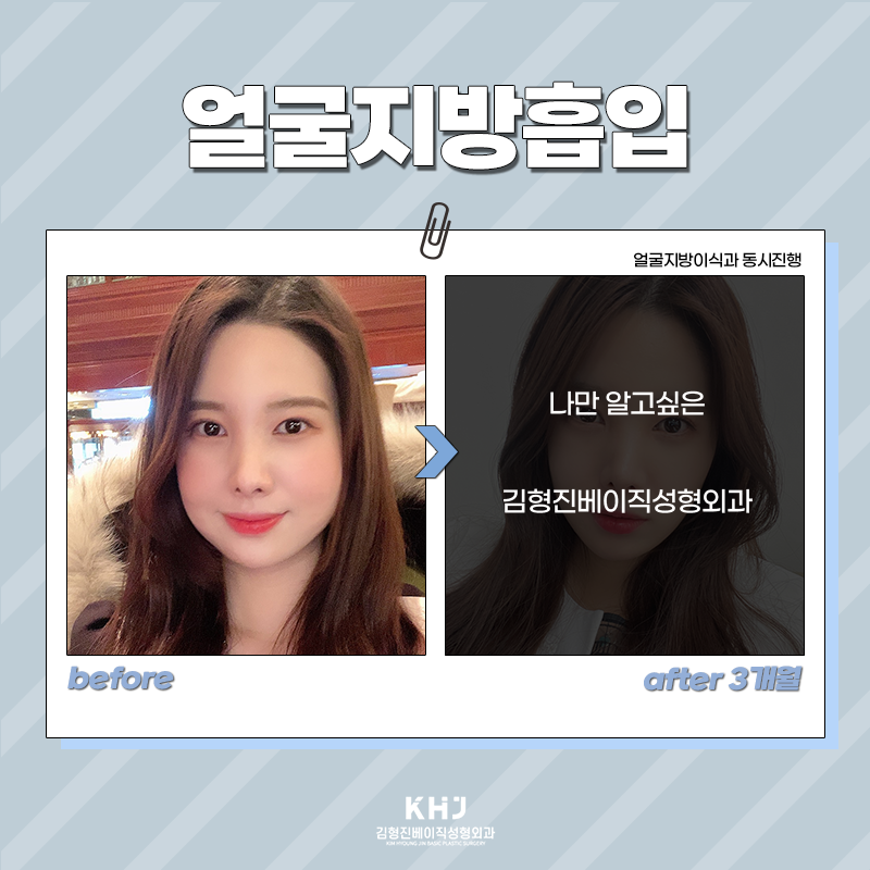 얼굴지방흡입수술 어떻게 진행되냐면요 관련 이미지 2