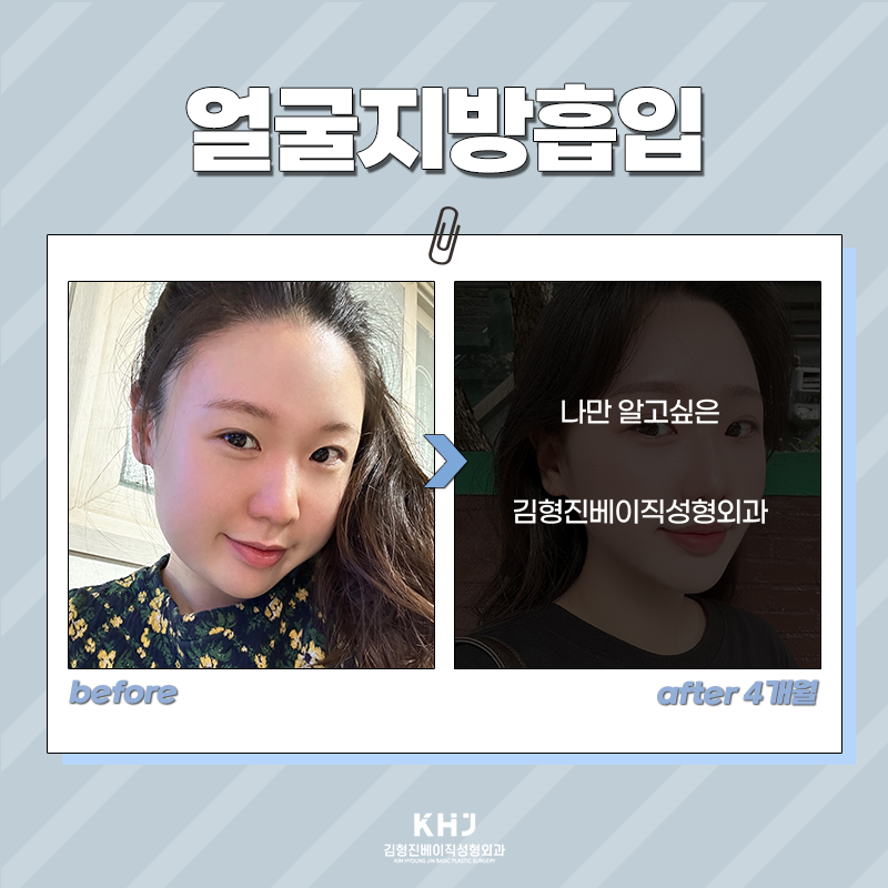 얼굴지방흡입수술 어떻게 진행되냐면요 관련 이미지 5