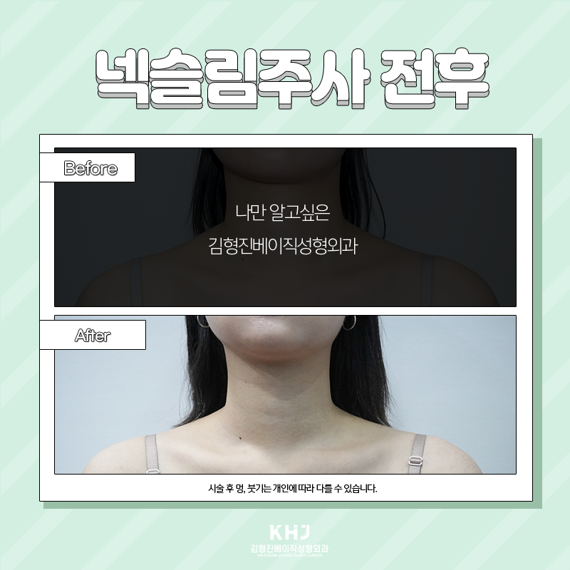 두꺼운목 해결방법 여기에요! 관련 이미지 6