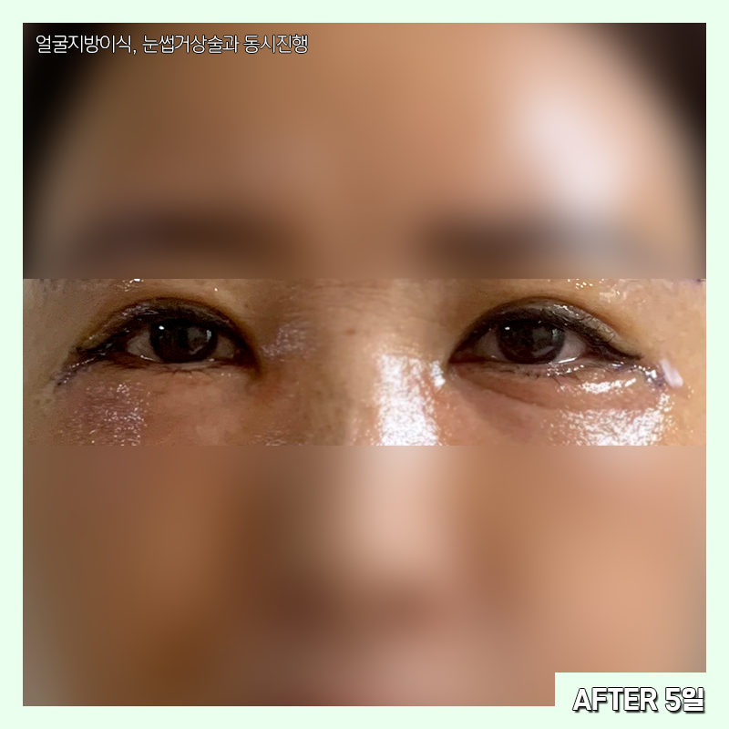 미니하안검붓기 궁금하셨다구요? 관련 이미지 4