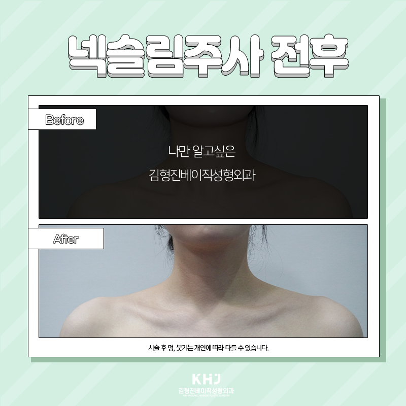 웨딩시술 고민하지 말고 김형진베이직에서! 관련 이미지 6