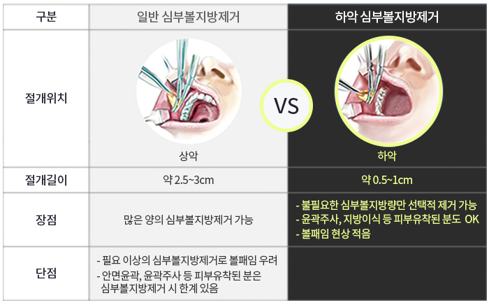하악심부볼지방제거 잘하는곳에서 해야죠 관련 이미지 5