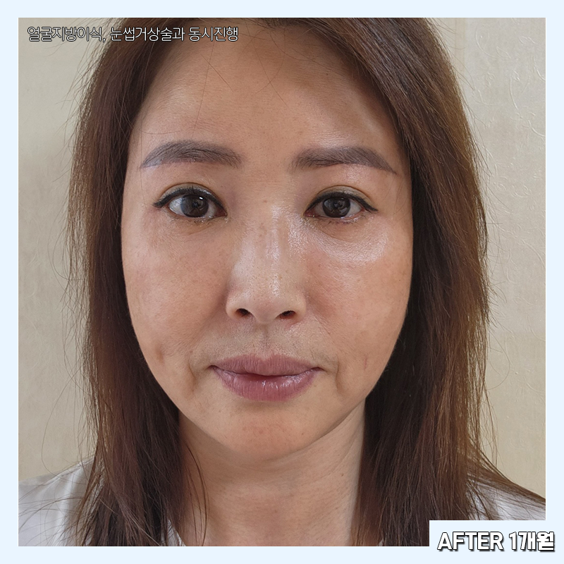 미니하안검회복과정 확인하고 가세요! 관련 이미지 5