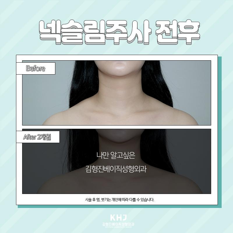 넥슬림주사전후 확인하고 가세요~! 관련 이미지 3