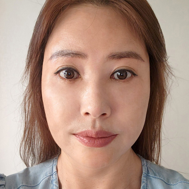 Solving Under-Eye Surgery for Middle Age with Mini Lower Blepharoplasty! image 1