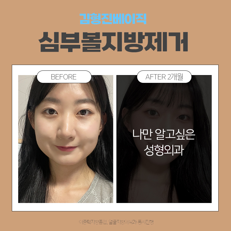 볼살제거 하고 V라인 장착하고 왔어요! 관련 이미지 5
