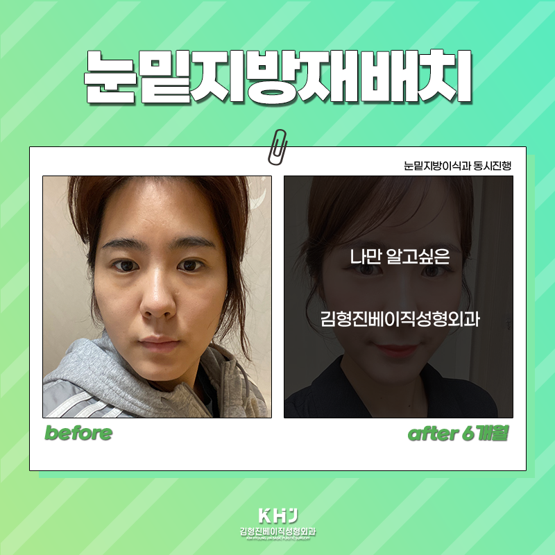 눈밑지방재배치전후 보러 오실래요~? 관련 이미지 2