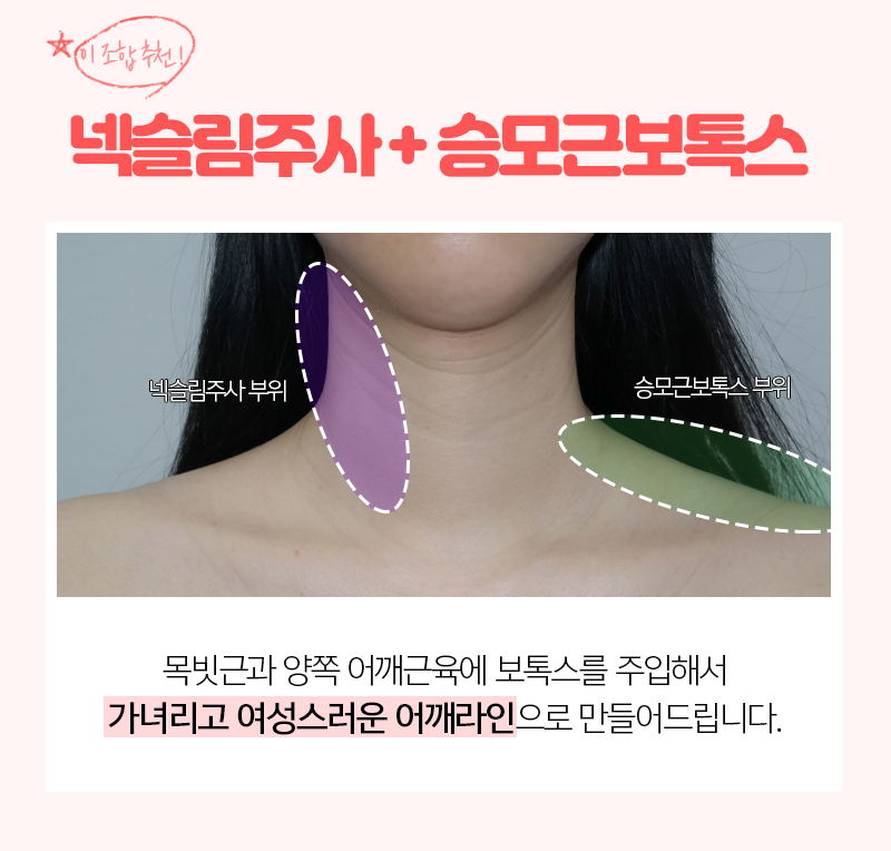 두꺼운목선, 과연 갸름해질 수 있을까? 관련 이미지 5