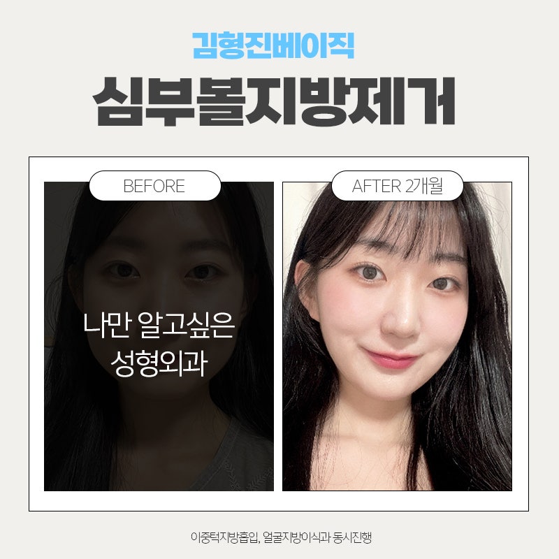 심부볼제거후기 이정도는 돼야죠 관련 이미지 3