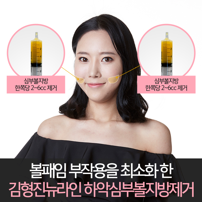 하악심부볼지방제거 안전과 부작용을 생각한다면 관련 이미지 5