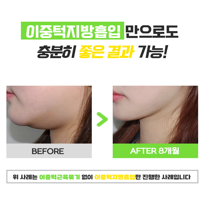 당신만 몰랐던 진짜 턱살없애는방법 알고싶다면 관련 이미지 6
