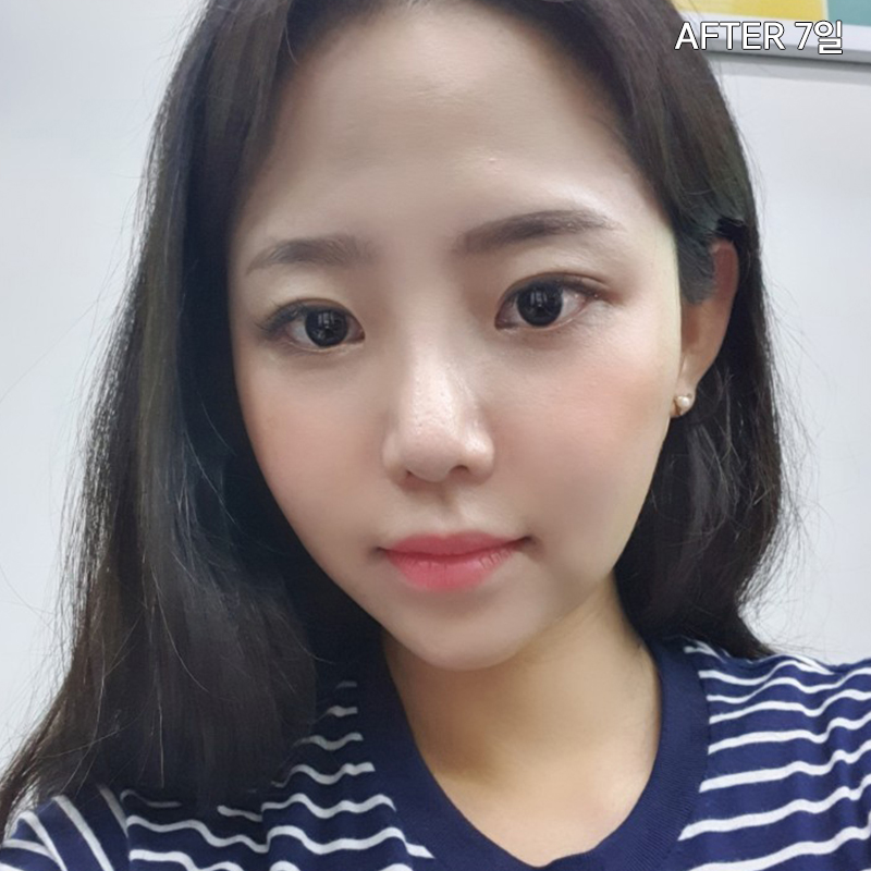 김형진베이직 얼굴지흡효과 좋다 좋아 관련 이미지 4
