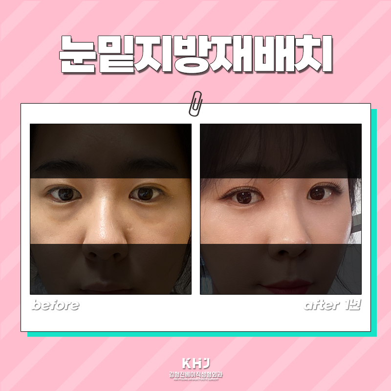 눈밑지방없애는방법 궁금하셨던 분들 들어오세요! 관련 이미지 6